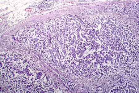 Lymph node cancer, light micrograph, photo under microscopeの写真素材