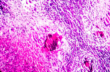 Caseous necrosis of lymphatic node, light micrograph, photo under microscopeの写真素材