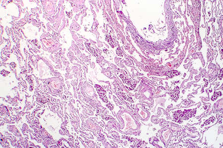 Chronic pulmonary congestion, light micrograph. Photo under microscopeの写真素材