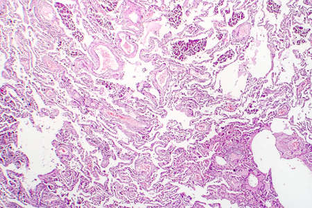 Chronic pulmonary congestion, light micrograph. Photo under microscopeの写真素材
