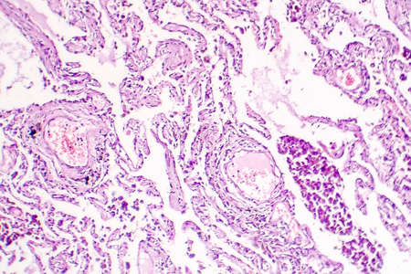 Chronic pulmonary congestion, light micrograph. Photo under microscope