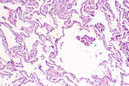 Chronic pulmonary congestion, light micrograph. Photo under microscopeの写真素材