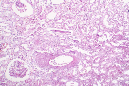 Tubular epithelial edema, light micrograph, photo under microscopeの写真素材
