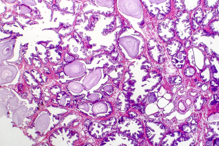 Benign prostatic hyperplasia. Micrograph shows dilated glands, papillary projections inside the lumen of the glands, cystic dilatation with accumulation of secretory material. Photo under microscopeの写真素材