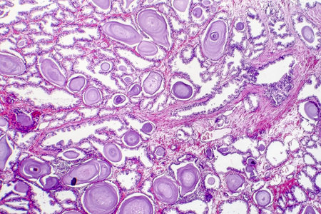 Benign prostatic hyperplasia. Micrograph shows dilated glands, papillary projections inside the lumen of the glands, cystic dilatation with accumulation of secretory material. Photo under microscopeの写真素材