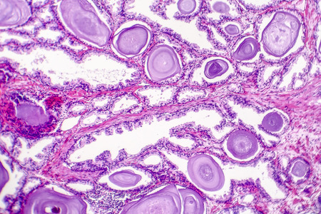 Benign prostatic hyperplasia. Micrograph shows dilated glands, papillary projections inside the lumen of the glands, cystic dilatation with accumulation of secretory material. Photo under microscopeの写真素材