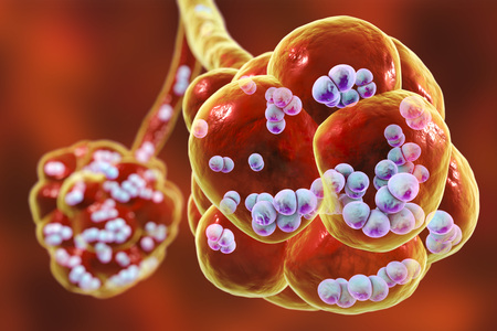Pneumococcal pneumonia, medical concept. 3D illustration showing bacteria Streptococcus pneumoniae...