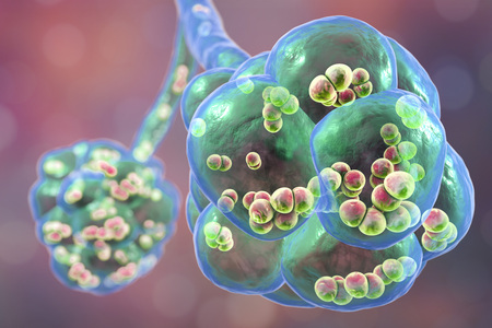 Pneumococcal pneumonia, medical concept. 3D illustration showing bacteria Streptococcus pneumoniae...