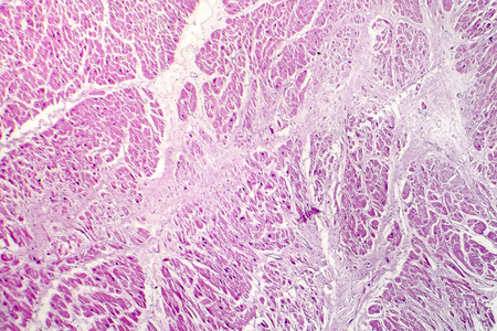 Acute myocardial infarction, histology of heart tissue, light micrograph. Area of infarct is paler than the relatively viable area of heart muscleの写真素材