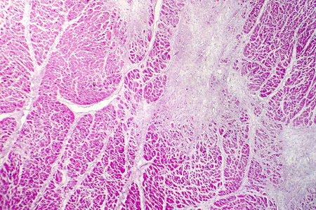 Acute myocardial infarction, histology of heart tissue, light micrograph. Area of infarct is paler...