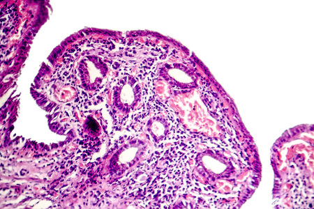 Chronic cholecystitis, light micrograph, photo under microscope showing fibrosis and muscular hypertrophy of gallbladder wall, entrapped epithelial crypts, foamy macrophagesの写真素材