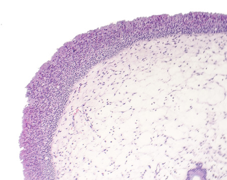 Inflammatory polyp, light micrograph, photo under microscopeの写真素材