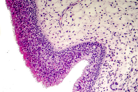 Inflammatory polyp, light micrograph, photo under microscope