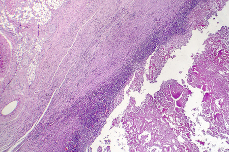 Pericarditis, inflammation of the heart pericardium, light micrograph, photo under microscope with...