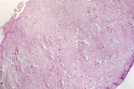 Foreign body granuloma, light micrograph, photo under microscopeの写真素材