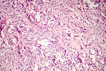 Foreign body granuloma, light micrograph, photo under microscopeの写真素材
