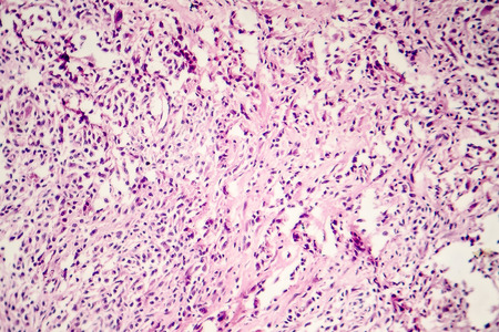Foreign body granuloma, light micrograph, photo under microscopeの写真素材