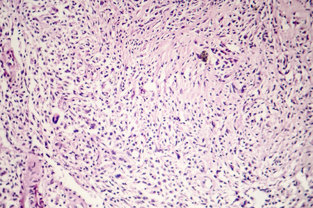 Foreign body granuloma, light micrograph, photo under microscopeの写真素材