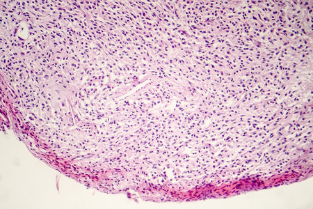 Foreign body granuloma, light micrograph, photo under microscopeの写真素材
