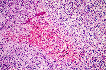 Inflammation and hemorrhage, light micrograph showing different inflammatory cells and red blood cells, photo under microscopeの写真素材