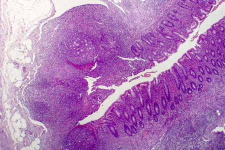 Suppurative appendicitis, light micrograph, photo under microscope showing neutrophilic infiltrates...