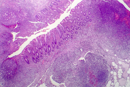 Suppurative appendicitis, light micrograph, photo under microscope showing neutrophilic infiltrates of the appendix wallの写真素材