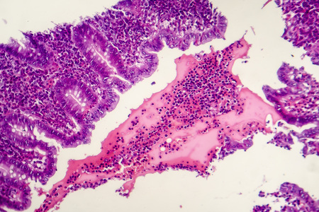 Suppurative appendicitis, light micrograph, photo under microscope showing neutrophilic infiltrates of the appendix wall and lumenの写真素材
