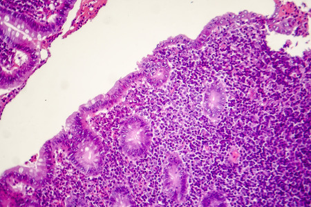 Suppurative appendicitis, light micrograph, photo under microscope showing neutrophilic infiltrates of the appendix wallの写真素材