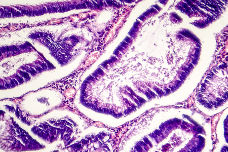 Intestinal polypoid adenoma, light micrograph, photo under microscope