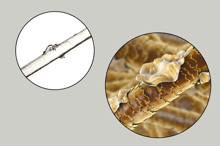 Human hair with dandruff, close-up view, photo under microscope and 3D illustration