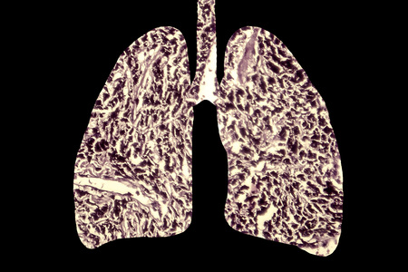 Smokers lungs, medical concept, 3D illustration showing outline of lungs and light micrograph of...