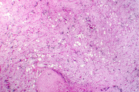 Liposarcoma, soft tissue sarcoma, light micrograph, photo under microscopeの写真素材