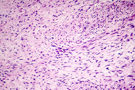 Fibroma, a benign tumour of fibrous tissue, light micrograph, photo under microscopeの写真素材