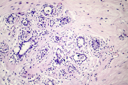 Hard breast cancer, light micrograph, photo under microscopeの写真素材