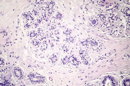 Hard breast cancer, light micrograph, photo under microscopeの写真素材