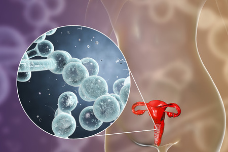 Vaginal thrush, female candidiasis, 3D illustration showing fungal vaginitis and close-up view of...