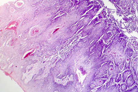 Cutaneous squamous cell carcinoma, light micrograph, photo under microscope showing typical keratinous pearlsの写真素材