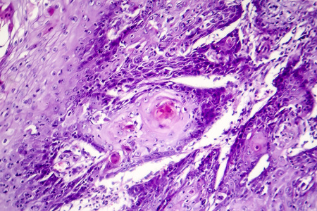 Cutaneous squamous cell carcinoma, light micrograph, photo under microscope showing typical...
