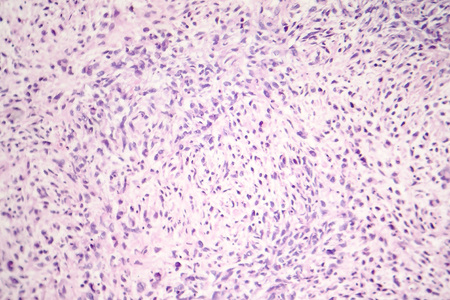 Light micrograph of malignant cells, photo of cancerous tumor under microscopeの写真素材