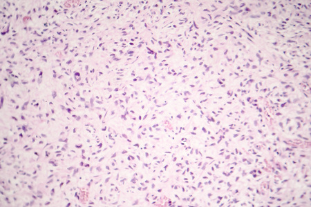 Light micrograph of malignant cells, photo of cancerous tumor under microscopeの写真素材