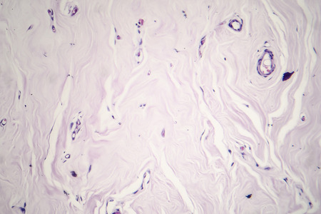 Fibroadenoma, a benign brest tumor, light micrograph, photo under microscopeの写真素材