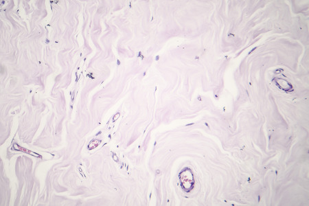 Fibroadenoma, a benign brest tumor, light micrograph, photo under microscopeの写真素材