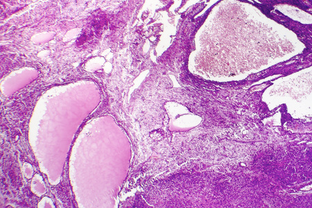 Fibrosarcoma, malignant tumor of fibroblasts, one of soft tissue sarcomas, light micrograph, photo under microscopeの写真素材