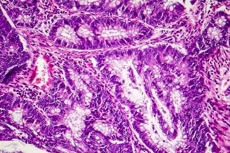 Colon adenocarcinoma, light micrograph, photo under microscope