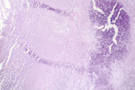 Aortic atherosclerosis, light micrograph, photo under microscope