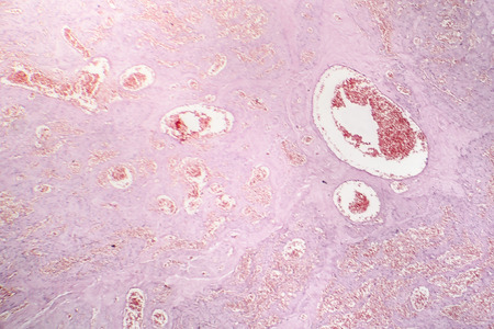 Capillary hemangioma, light micrograph, photo under microscopeの写真素材