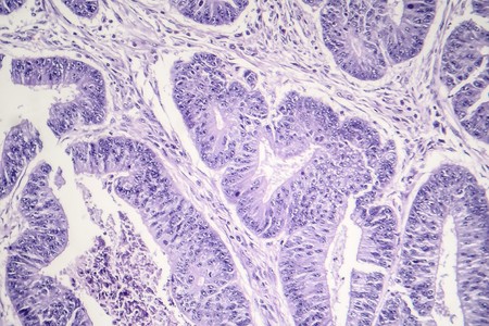 Esophageal squamous cell carcinoma, light micrograph, photo under microscopeの写真素材