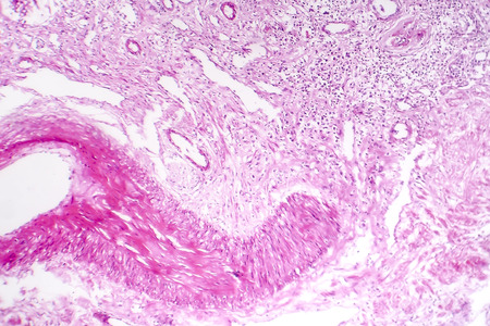 Contracted kidney, light micrograph, photo under microscopeの写真素材
