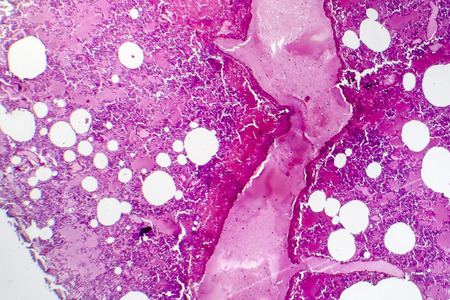 Lobar pneumonia, hemorrhagic edema period, light micrograph, photo under microscope