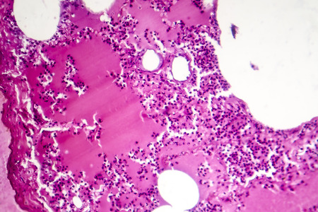 Lobar pneumonia, hemorrhagic edema period, light micrograph, photo under microscope